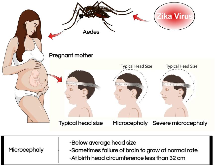 Zika provoke microcephaly large