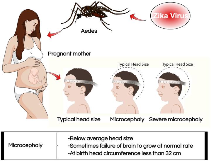 Zika provoke microcephaly small