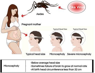 Zika provoke microcephaly extra small